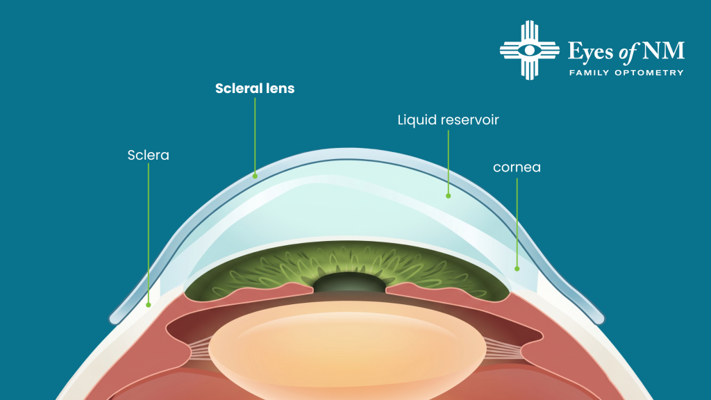 Advanced scleral lens technology uses detailed corneal mapping for highly personalized lens fittings.
